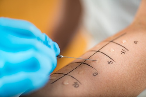 What To Expect During An Allergy Test