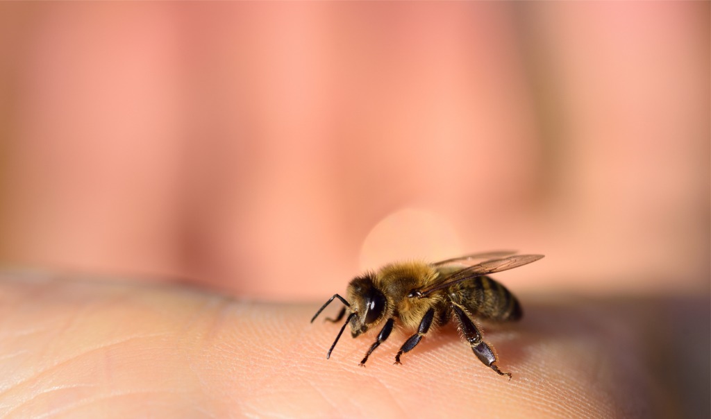 bee sting allergic reaction neck