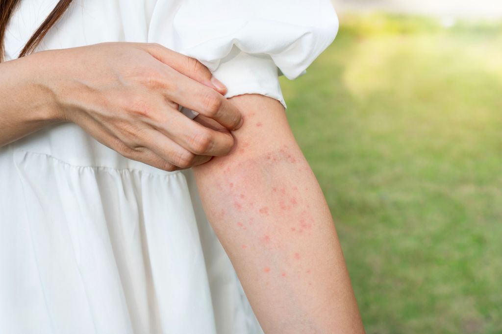 Hives Vs. Bug Bites: How To Tell The Difference