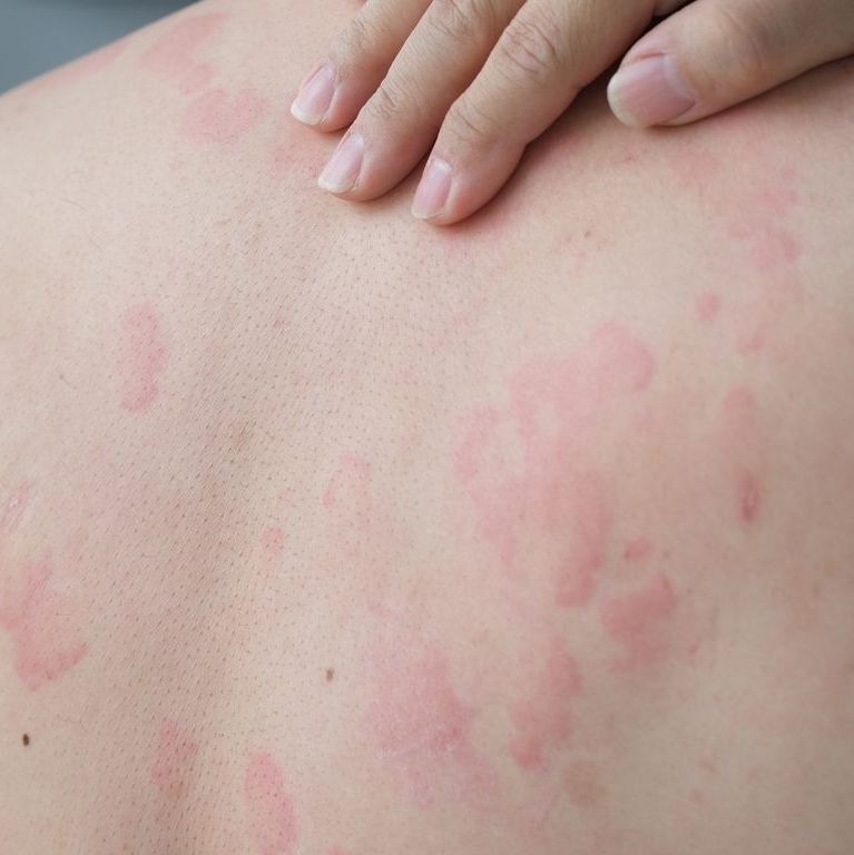 image of hives on back