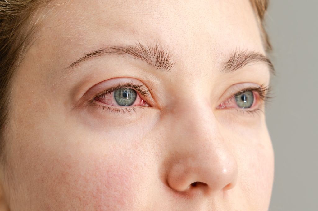 allergies-or-pink-eye-how-to-tell-the-difference