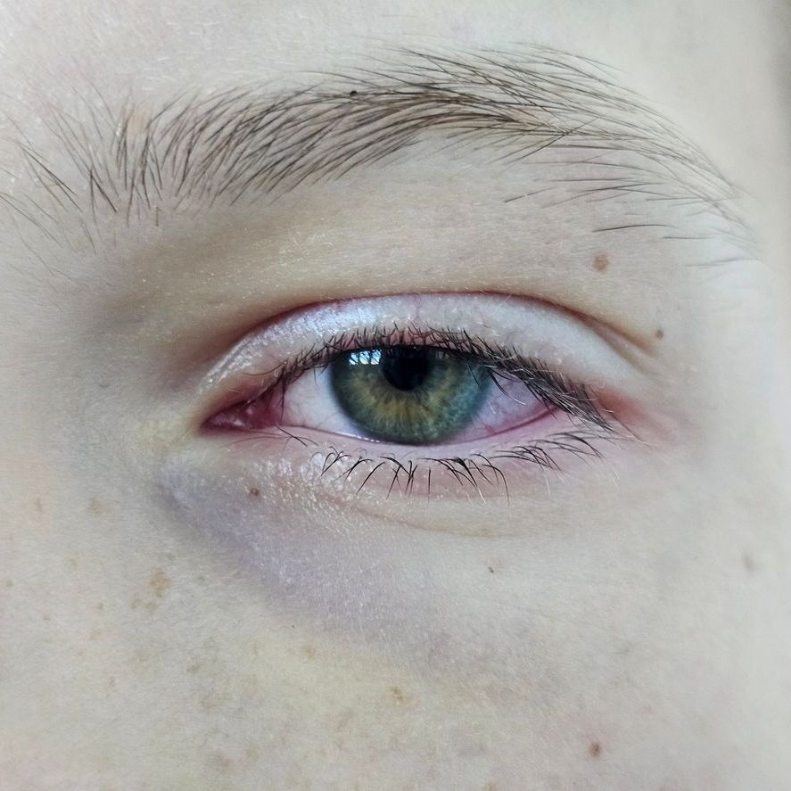 Allergic Conjunctivitis example