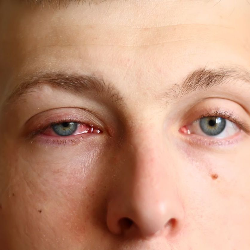 pink eye example